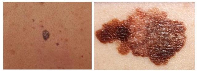 melanoma 1