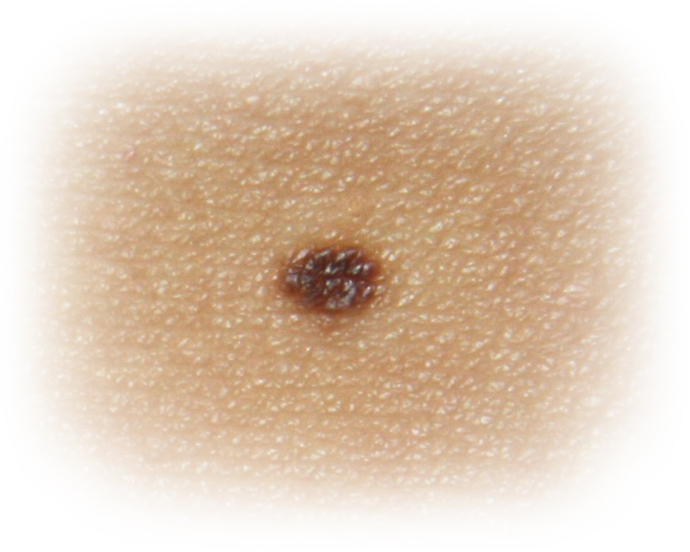 dermatoskopiya 1